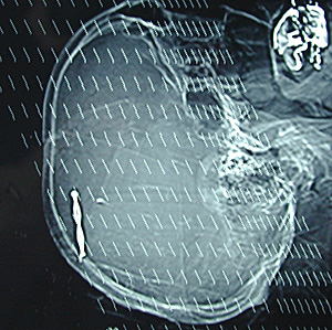Radiografa en la que se aprecia la broca en el crneo (Foto: El Mundo)