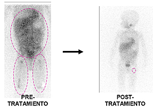 Imagen de la gamagrafa del paciente (Foto: Cancer Gene Therapy)