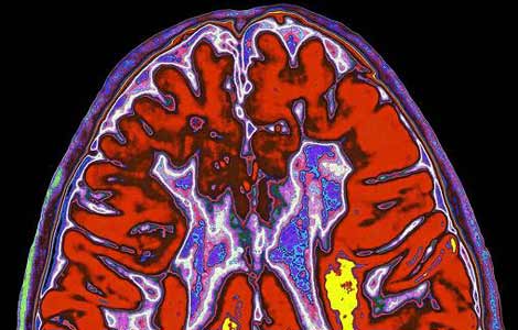 Cerebro de un enfermo con esclerosis múltiple. | El Mundo