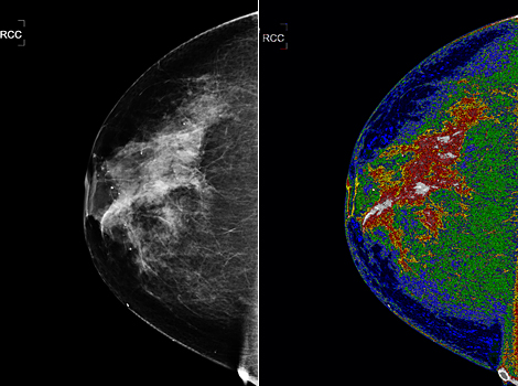 Mamografa normal (izqda.) y con MED-SEG (drcha.). | Bartron Medical Imaging