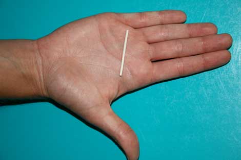 Detalle de un implante anticonceptivo. | ELMUNDO.es