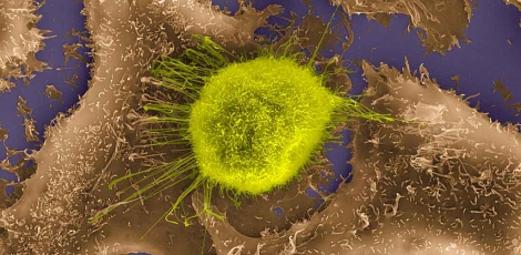 Célula epitelial tumoral en el pulmón. | Foto: Dennis Kunkel