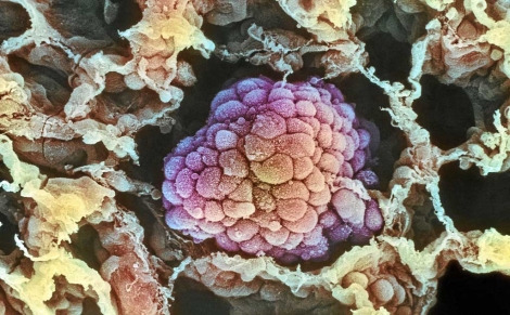 Imagen microscpica de un tumor. | Foto: Science Library.