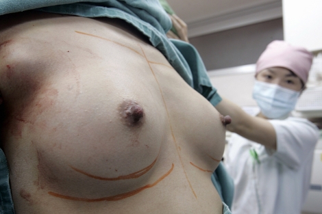 Una enfermera revisa los pechos recin operados de una paciente. | Reuters