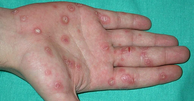 Clavos sifilíticos en las palmas de las manos. | OMC