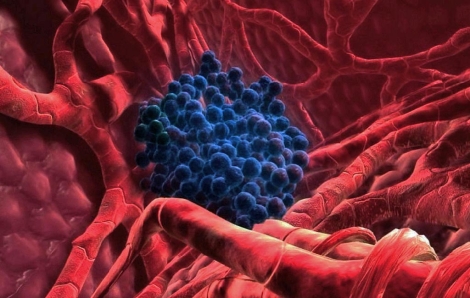Clulas tumorales en un hgado humano. | El Mundo