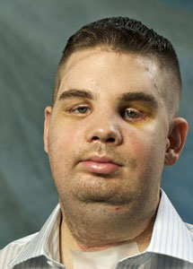 James Maki. Pinche para ver su cara antes del trasplante. | BWH