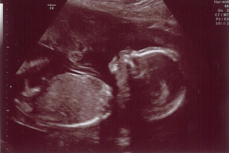 Ecografa de un feto de 20 semanas. | Ambernectar 13 | photopin
