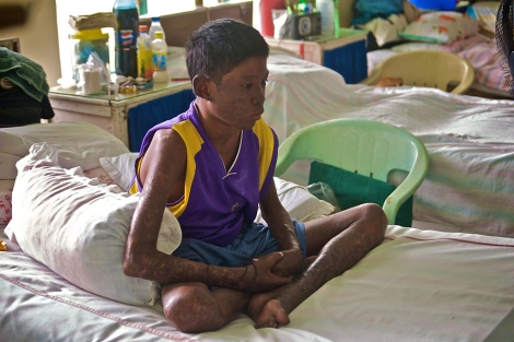 Chico filipino con lepra. | moyerphotos | Photopin