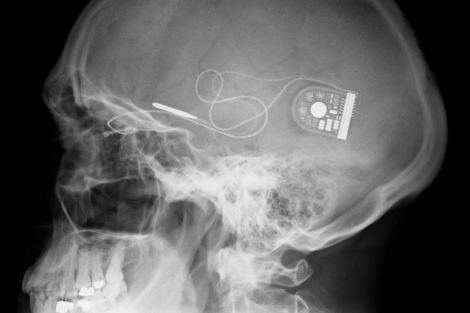 Radiografía que muestra dónde está colocado el implante. | H. Oftalmológico de Oxford