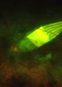 Imagen del chip colocado detrás del ojo. | H. Oftalmológico de Oxford