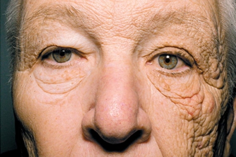Envejecimiento de la piel por el sol.| Jennifer R.S. Gordon, M.D. y Joaquin C. Brieva, M.D. | NEJM