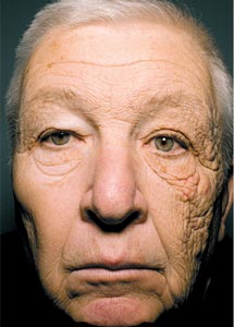 Amplíe para ver el rostro completo de este paciente de 69 años.| Jennifer R.S. Gordon, M.D. y Joaquin C. Brieva, M.D. | NEJM