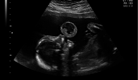 Ecografa del feto en la que se observa el tumor. | 'Am J Obstet Gynecol'