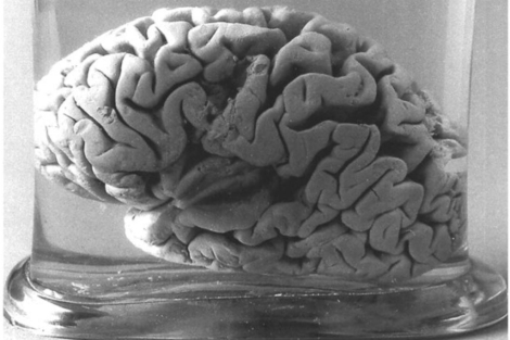 Imagen del famoso cerebro de Leborgne. | El Mundo