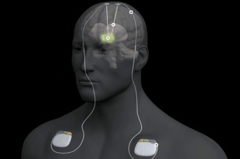 Ilustracin de un pacientes con Parkinson y con electrodos en su cerebro.