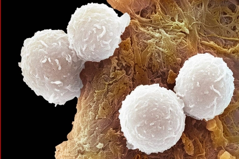 Imagen al microscopio de glbulos blancos afectados por la leucemia