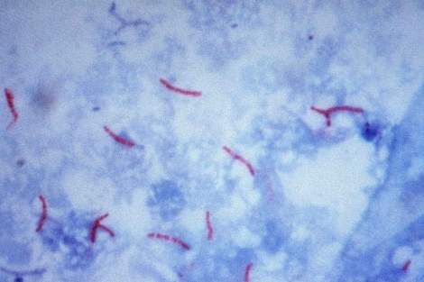 'Mycobacterium tuberculosis' al microscopio.| CDC