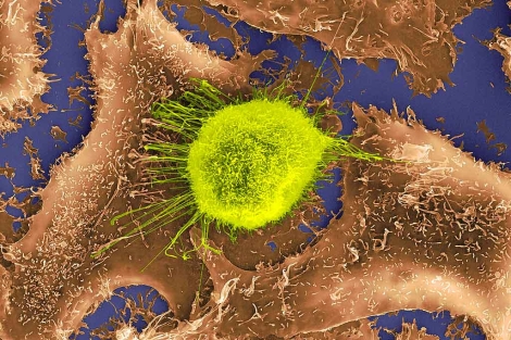 Imagen de una clula tumoral localizada en el pulmn.| Dennis Kunkel