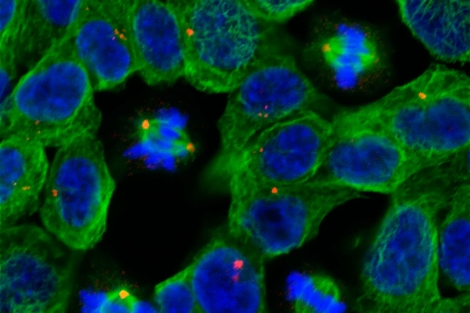 Imagen de clulas tumorales al microscopio.| Reuters