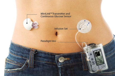 Una bomba de insulina y un sensor. | Medtronic