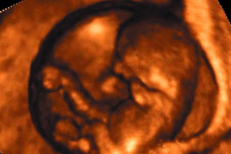 Vista de un feto de 10 semanas por la tcnica de ecografa 4 D. | El Mundo