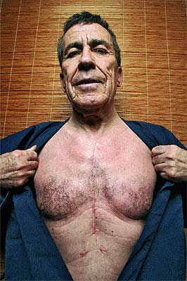 El escritor muestra la cicatriz de la operacin. Le intervinieron el 17 de diciembre de 2004