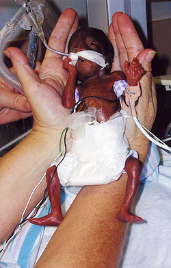 Amilia, el beb ms prematuro del mundo. (Foto: Reuters)
