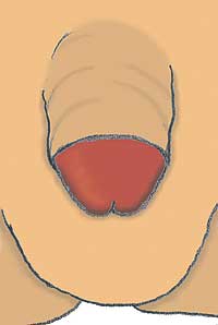 La recuperacin. El glande queda as al descubierto. La cicatrizacin suele ser rpida los puntos de sutura se reabsorben entre una y dos semanas y sin problemas, aunque las erecciones nocturnas pueden producir dolor.